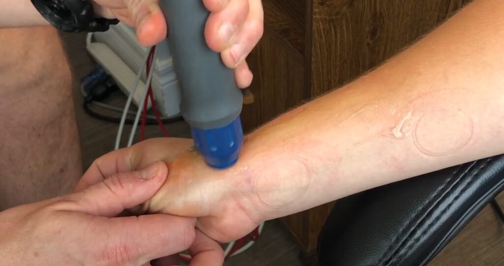 shockwave treatment on patients thumb with ultrasound gel, shockwave gun looks like large pen with blue contact head on patients skin