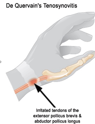 De quervains text thumb pain treatment oakville where it hurts on thumb side of wrist and hand