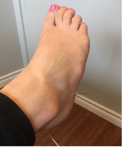 Oakville Acupuncture for ankle sprains, where the needles go in the foot and ankle