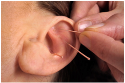 oakville acupuncture, three needles in patients ear. the needles are placed in the meaty part of the ear. looks like it might be painful/