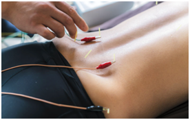 Oakville Acupuncture: 4 needles on the lower back of a paitent who is face down. There are leads attached tot he needles that look like the things you use to jump your car, just smaller.