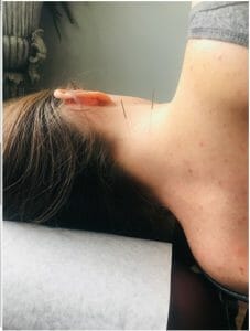 Acupuncture for Neck Pain