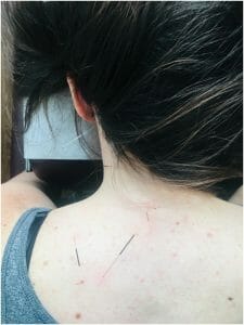 acupuncture for neck pain needles in levator scap