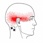 Headache pain pattern on side of patients neck and head