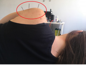 acupuncture needles in shoulder. 3 needles in shoulder of female patient