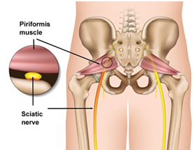 Piriformis Syndrome Treatment Doctors (Best Pain Specialists) Brooklyn