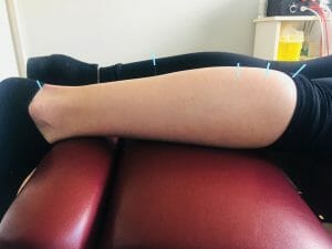 oakville acupuncture for sinus tarsi syndrome calve needles