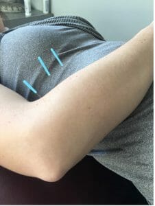 Acupuncture for Tennis Elbow