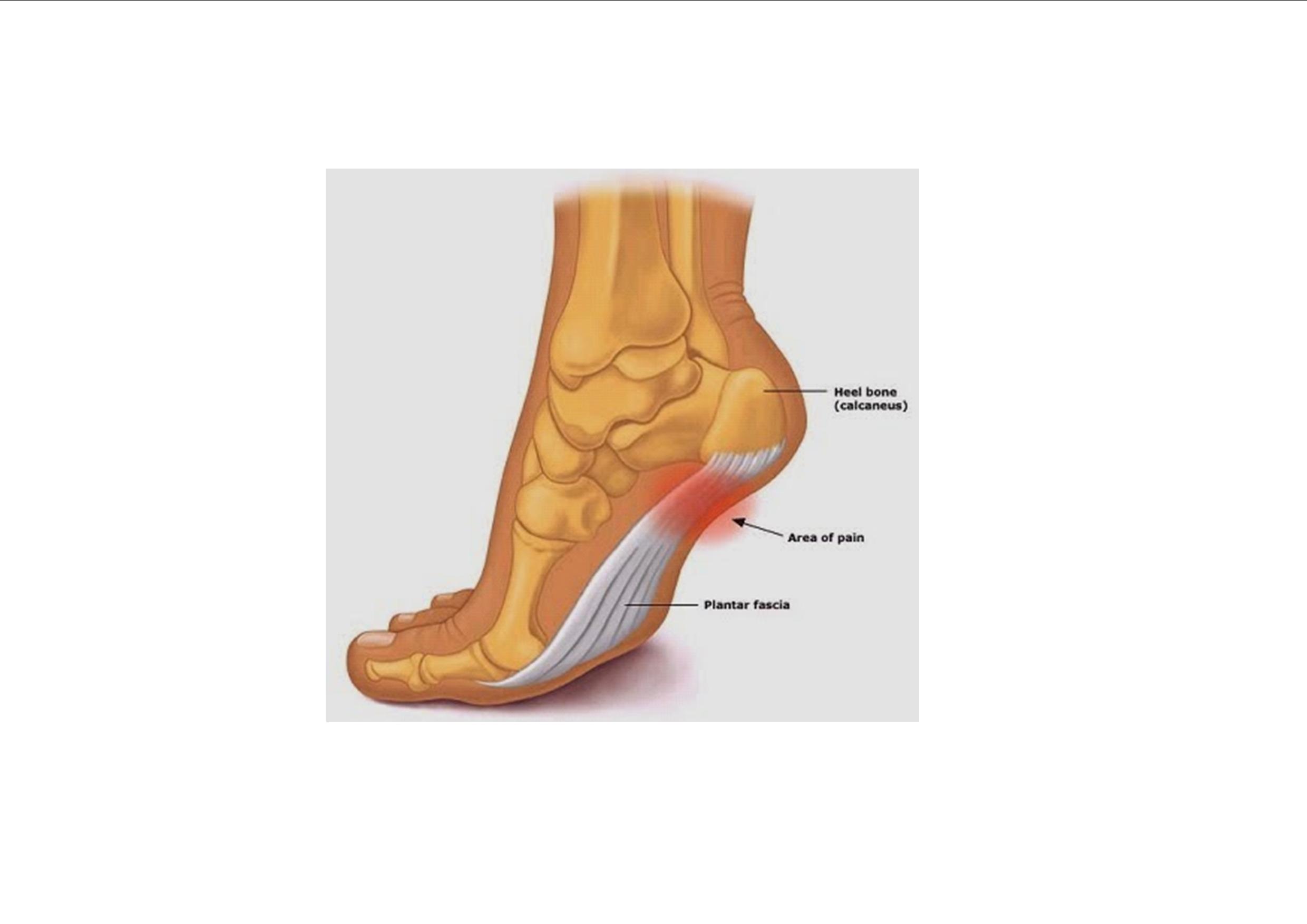 foot pain plantar fascia