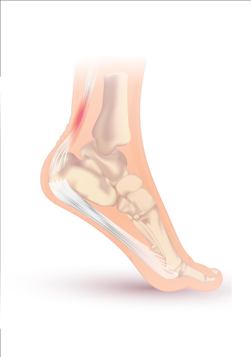 achilles tendon and plantar fasciitis meme