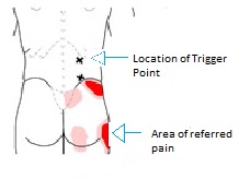 oakville chiropractor trigger point and ART