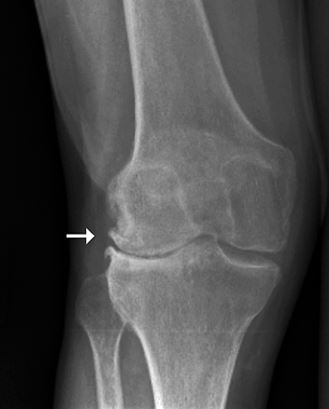 knee osteoarthritis xray