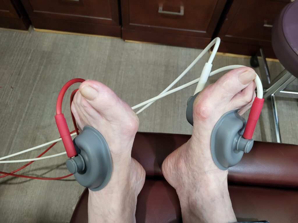 Suction electrical stim on a patients foot with bunions.