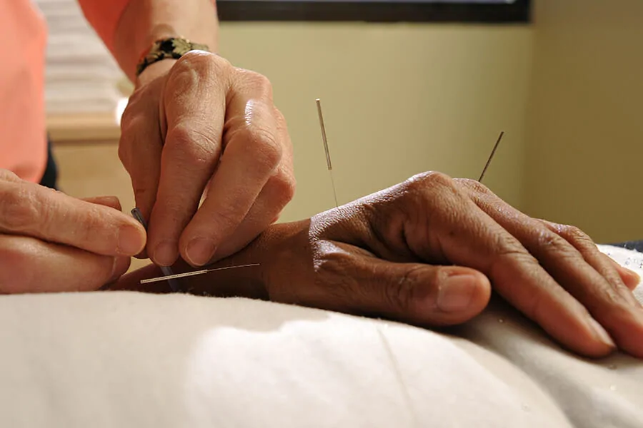 Acupuncture being performed on hand