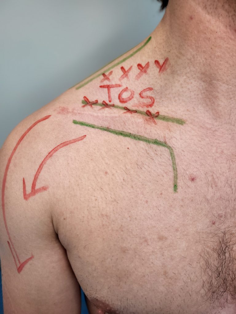 Marker diagram on a TOS patient. Thoracic Outlet is above the collar bone and below the neck muscle.
