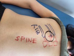 drawing on a patients back of a rib subluxation. a hot spot 1 inch from the spine under the shoulder blade