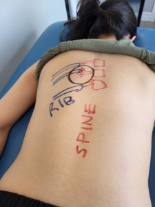 A picture showing marks on back, depicting cause of rib pain caused by a sports injury.