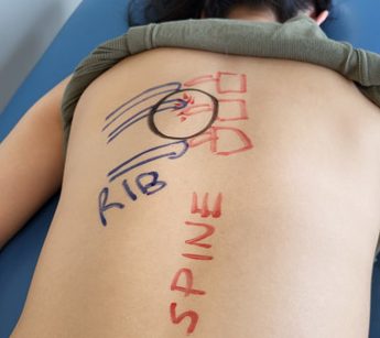A picture showing marks on back, depicting cause of rib pain caused by a sports injury.