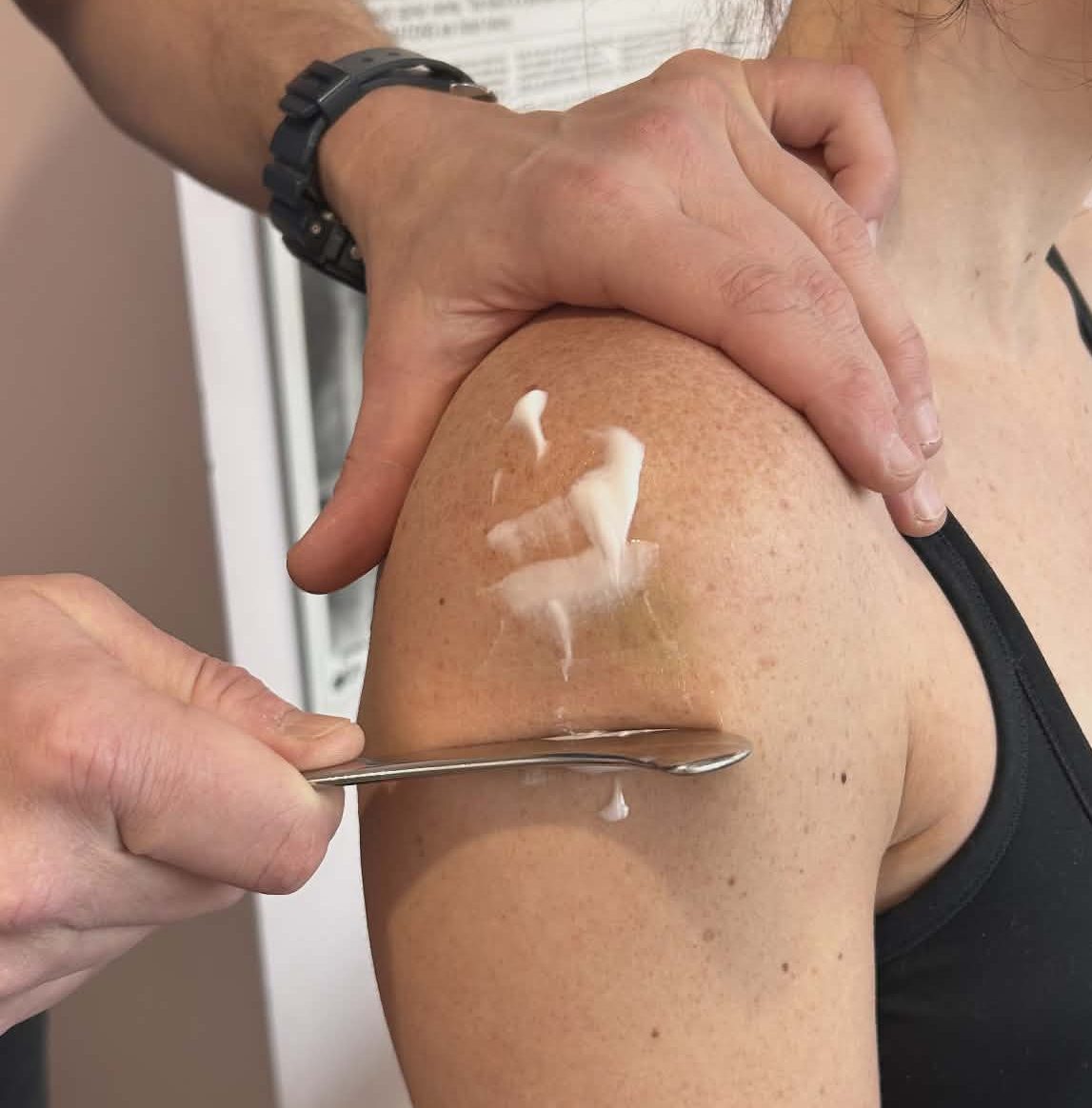 a scraping tool used on the outside of a female patients shoulder. looks like a thick butter knife against the skin