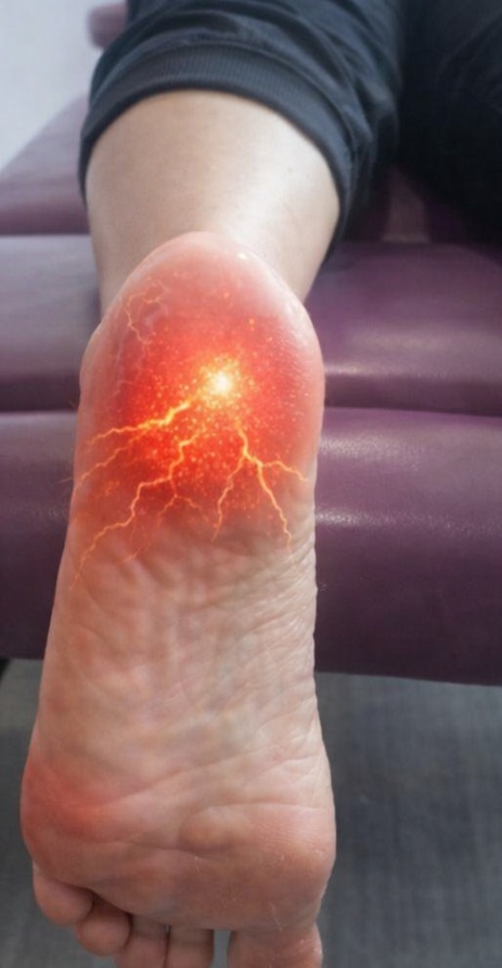 picture of the bottom of the foot with red painful heal