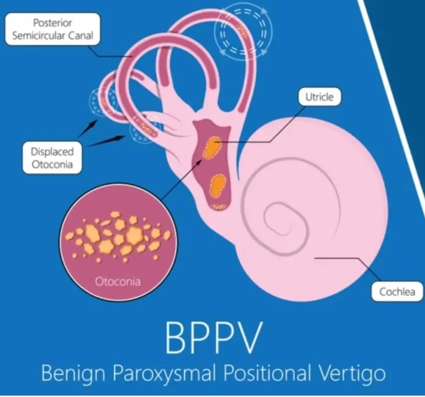 explanation of what causes bppv vertigo, the otoconia in the utricle get moved around and become displaced