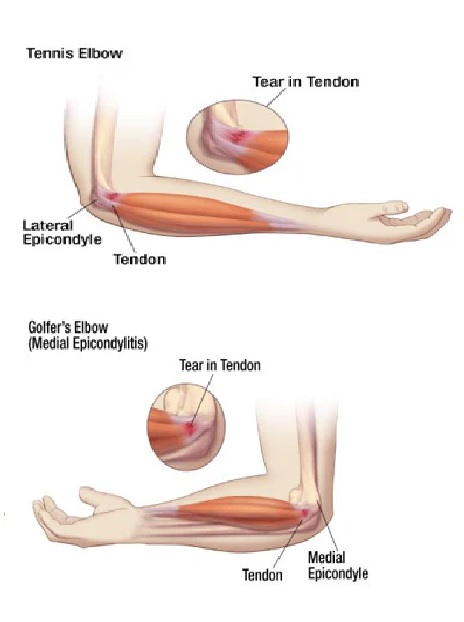 tennis elbow is on outside of elbow, golfers elbow is on the inside