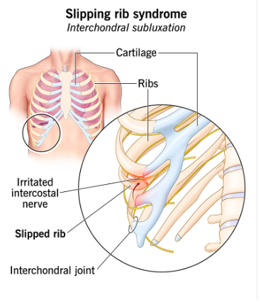 what is slipping rib syndrome, pain on the side or back of ribs lower in the rib cage, floating ribs