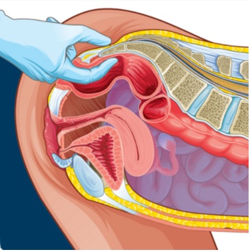 Cartoon of Dr. Alex placing his finger beyond the anal verge to adjust a patients coccyx or tailbone.