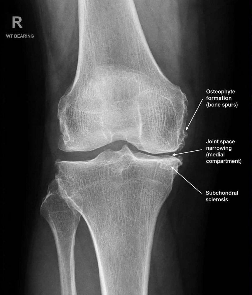 xray of a knee with osteoarthritis