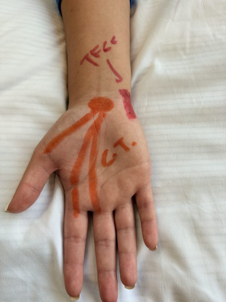 Patients arm and hand with drawings of wear carpal tunnel is and where TFCC injury pain would be.