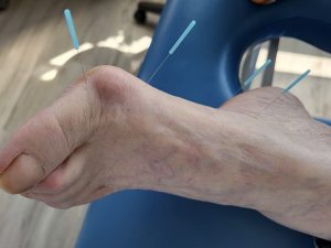 needles in foot for bunion