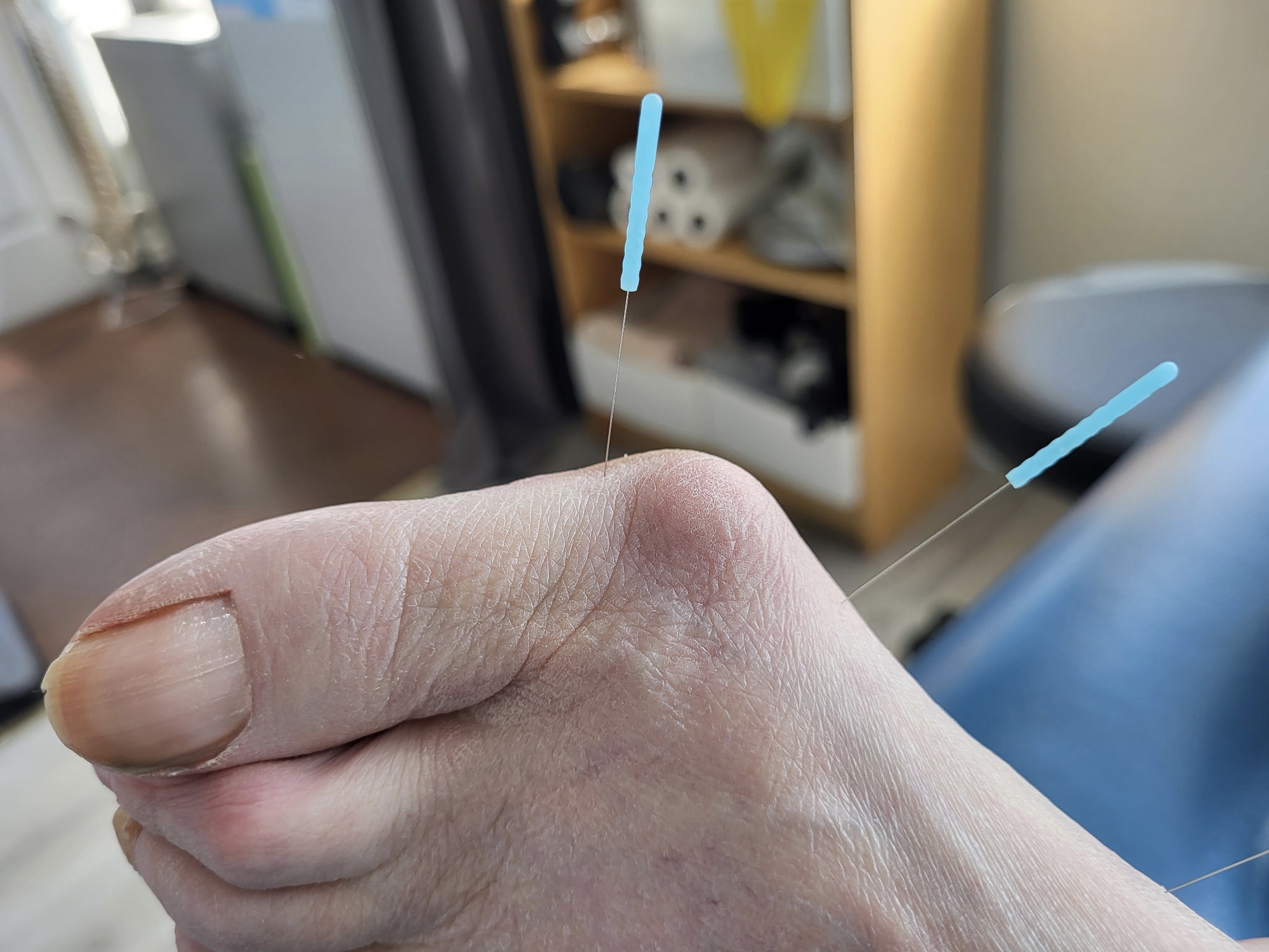 acupuncture needles around a bunion